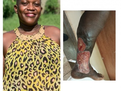 HELP SAVE SYLVIAS LEG AND GIVE HER A SMILE.